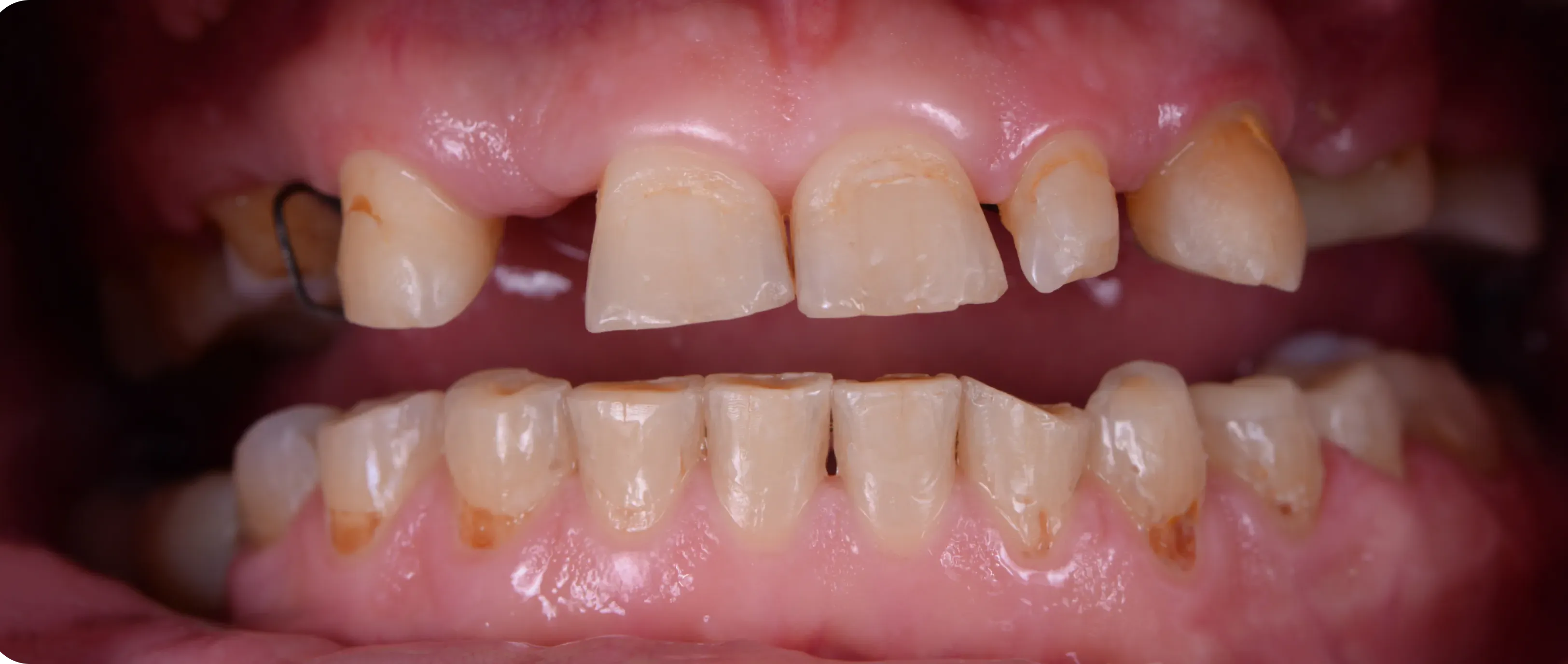 Before dental treatment